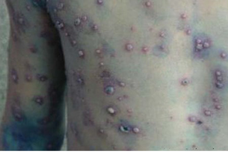 Hình ảnh minh họa bệnh thủy đậu